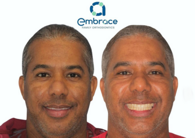 Embrace Family Orthodontics | Before and After Photos