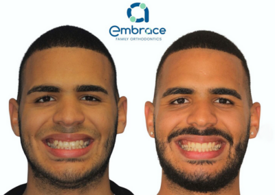 Embrace Family Orthodontics | Before and After Photos