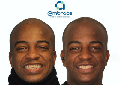 Embrace Family Orthodontics | Before and After Photos