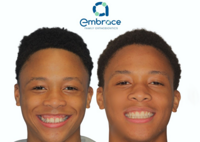 Embrace Family Orthodontics | Before and After Photos