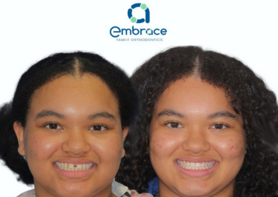 Embrace Family Orthodontics | Before and After Photos