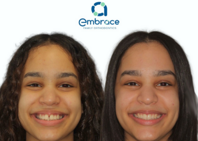 Embrace Family Orthodontics | Before and After Photos