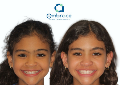 Embrace Family Orthodontics | Before and After Photos