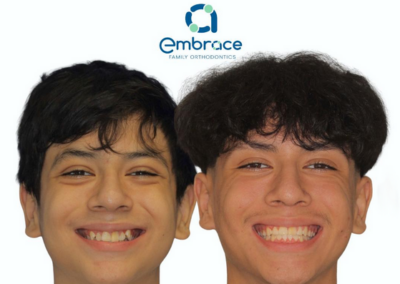 Embrace Family Orthodontics | Before and After Photos
