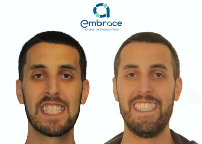 Embrace Family Orthodontics | Before and After Photos