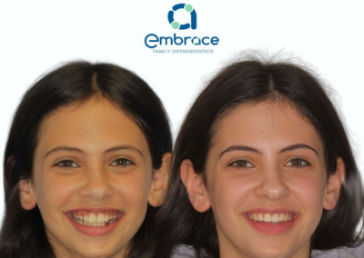 Embrace Family Orthodontics | Before and After Photos