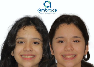 Embrace Family Orthodontics | Before and After Photos