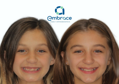 Embrace Family Orthodontics | Before and After Photos