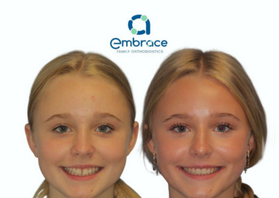 Embrace Family Orthodontics | Before and After Photos
