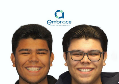 Embrace Family Orthodontics | Before and After Photos