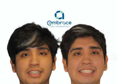Embrace Family Orthodontics | Before and After Photos