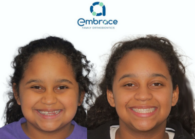 Embrace Family Orthodontics | Before and After Photos