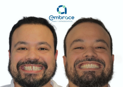 Embrace Family Orthodontics | Before and After Photos