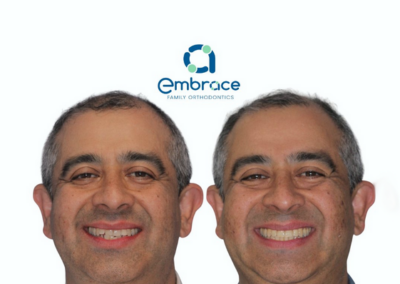 Embrace Family Orthodontics | Before and After Photos