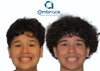 Embrace Family Orthodontics | Before and After Photos