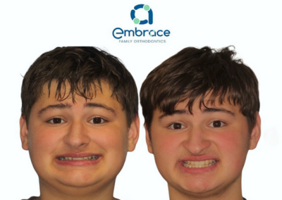 Embrace Family Orthodontics | Before and After Photos
