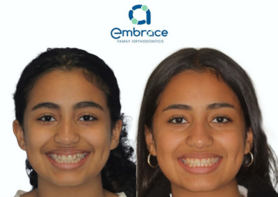 Embrace Family Orthodontics | Before and After Photos