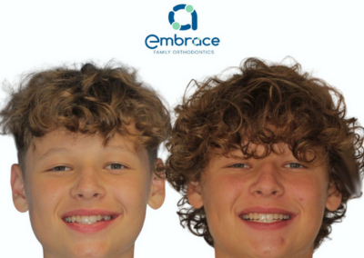 Embrace Family Orthodontics | Before and After Photos