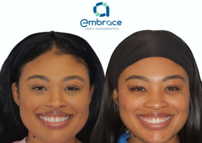 Embrace Family Orthodontics | Before and After Photos